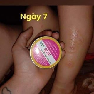Kem đa năng Mul Rose trị mụn, viêm da cơ địa, mẫn ngứa, hăm sảy, rạn nứt da