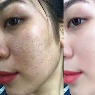 cao đặc trị mụn nám tàn nhang