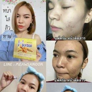 Kem nghệ trị mụn herbal