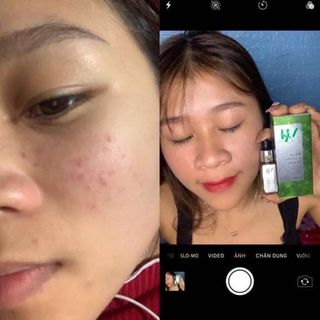 Trị mụn Dr. Mai