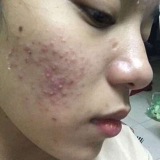 Trị mụn Dr. Mai