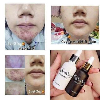 CẶP ĐÔI SERUM TRỊ MỤN +DƯỠNG DA SPEELING