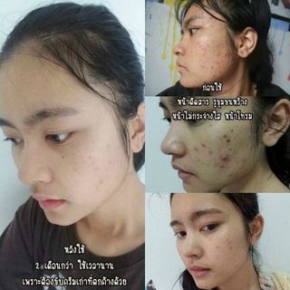 CẶP ĐÔI SERUM TRỊ MỤN +DƯỠNG DA SPEELING