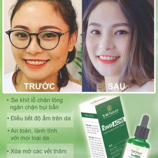 Vua trị mụn King Acne