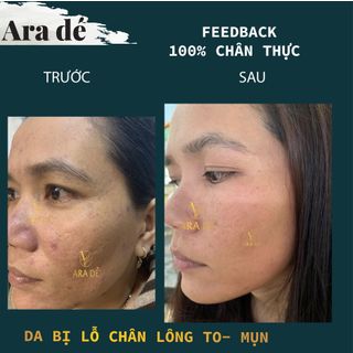 ARA DÉ CHAI NHỎ 50ml - Sỉ Chiết Khấu 40%
