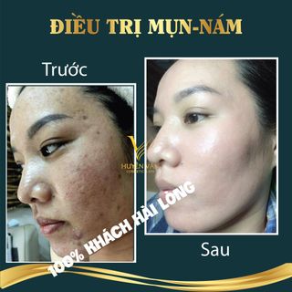 ARA DÉ CHAI LỚN 100ml - Sỉ Chiết Khấu 40%