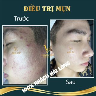 ARA DÉ CHAI LỚN 100ml - Sỉ Chiết Khấu 40%