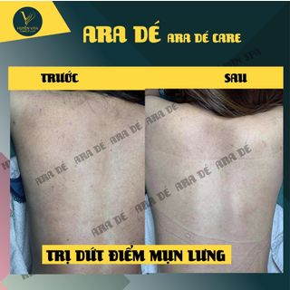 ARA DÉ CHAI LỚN 100ml - Sỉ Chiết Khấu 40%