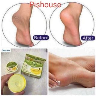 Kem trị nứt gót chân chuối