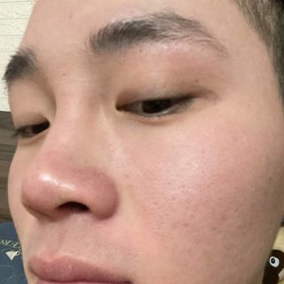 Sảm phẩm trị mụn