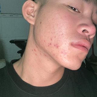 Sảm phẩm trị mụn