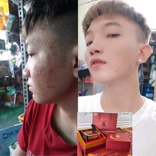 Cao mụn sâm đỏ 36 vị thuốc