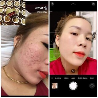 Cao mụn sâm đỏ 36 vị thuốc