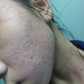Tinh Chất Trị Mụn Nun Platinum Acnes