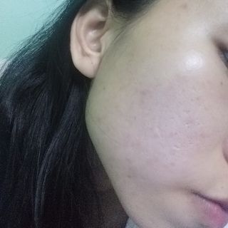 Tinh Chất Trị Mụn Nun Platinum Acnes