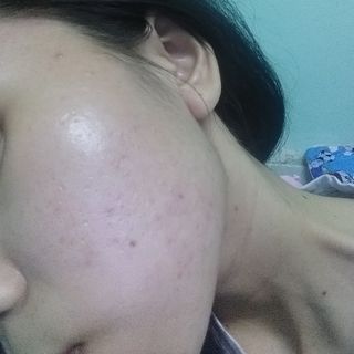 Tinh Chất Trị Mụn Nun Platinum Acnes
