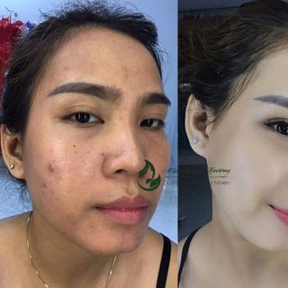 Serum Đánh Bay Mụn Thâm Mộc Thiên Hương 100ml