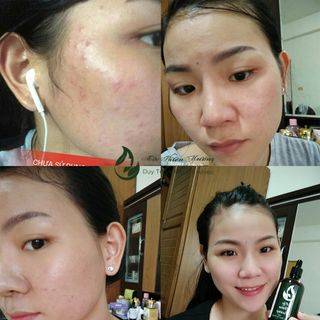 Serum Đánh Bay Mụn Thâm Mộc Thiên Hương 100ml