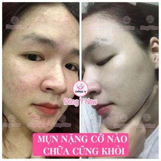 Sỉ 50 hộp- trị mụn hoa đào đông y- Hoàng Liên PP Toàn quốc
