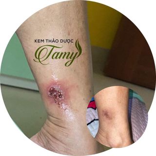Kem Thảo Dược Trị Bệnh Ngoài Da Tamy