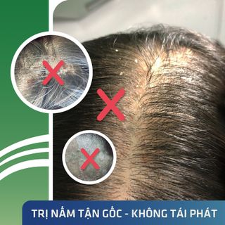 Thuốc trị nấm da đầu Ezema 50 - Đặc trị nấm tóc, nấm da đầu, vảy nến da đầu, viêm da tiết bã chiết xuất Gurjun Ấn Độ - Lọ 50gr