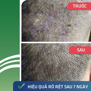 Thuốc trị nấm da đầu Ezema 50 - Đặc trị nấm tóc, nấm da đầu, vảy nến da đầu, viêm da tiết bã chiết xuất Gurjun Ấn Độ - Lọ 50gr