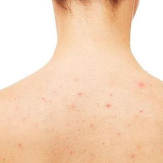 Kem trị viêm nang lông Nhật Bản