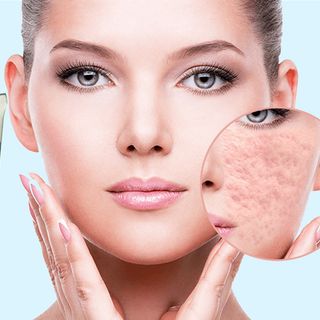 Kem sẹo Nga,làm mờ sẹo lồi, sẹo lõm và sẹo rỗ và vết thâm