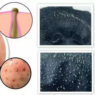 Gel Lột Mụn Lê Thanh - Lột Sạch Mụn Cám, Mụn Đầu Đen Hiệu Quả