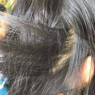 Ủ Chấy Chí. Dầu Gội Trị Chấy Chí. Ủ Chấy Cho Bé. Thuốc Ủ