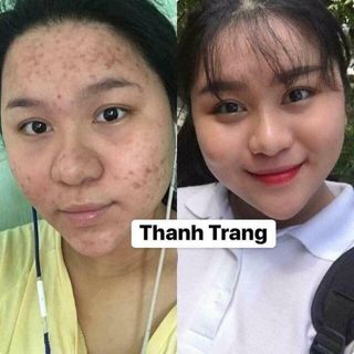 Thuốc Trị Mụn Nám