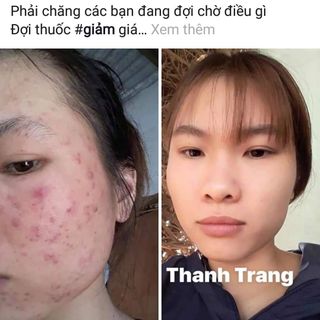 Thuốc Trị Mụn Nám