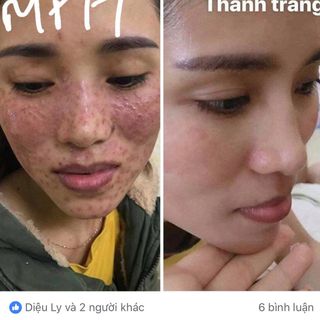 Thuốc Trị Mụn Nám