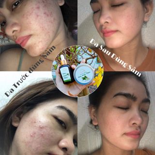Combo Sâm Linh Thảo Trị Mụn