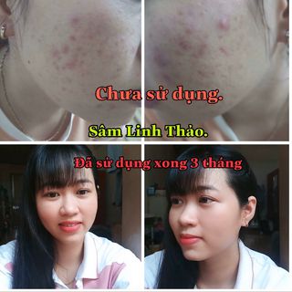 Combo Sâm Linh Thảo Trị Mụn