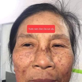 FACE TRỊ NÁM, TÀN NHANG