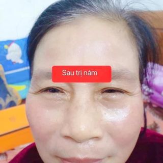 FACE TRỊ NÁM, TÀN NHANG
