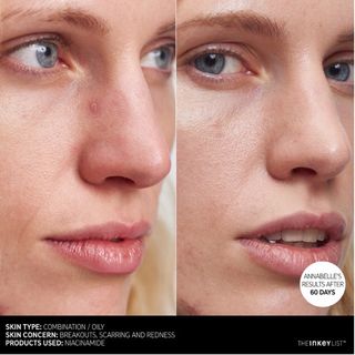 Tinh Chất Se Khít Lỗ Chân Lông THE INKEY LIST Niacinamide Oil Control Serum 30ml