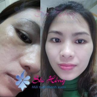 Serum trị mụn - mờ nám cao cấp Sắc Hồng - 30ml