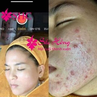 Serum trị mụn - mờ nám cao cấp Sắc Hồng - 30ml