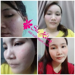 Serum trị mụn - mờ nám cao cấp Sắc Hồng - 30ml
