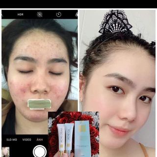 Combo trị mụn Acommentish