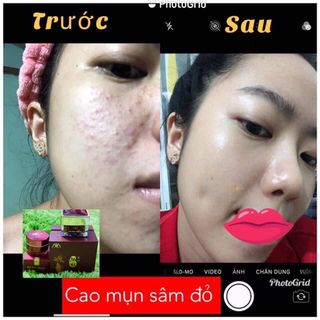 Cao mụn sâm đỏ