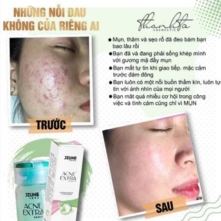 Serum Mụn Acne Extra Jiuhe
