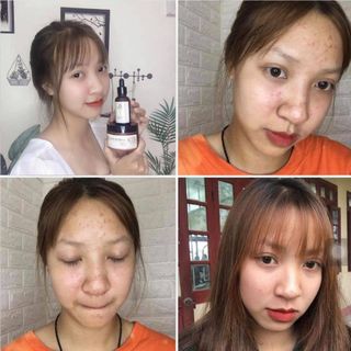 Serum Trị Mụn Bào Lão Cao Cấp Chuyên Sẹo Nám Tái Tạo
