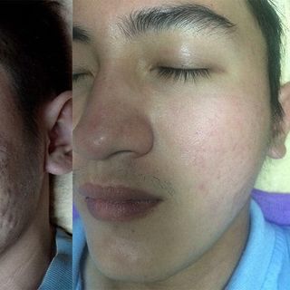 Serum Quét Sạch Mụn Thâm Rỗ EDORA - 3 Ngày Hiệu Quả Rõ Rệt - Tâm Sinh An Cosmetic - Mãi Mãi Tuổi 18