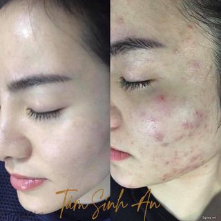 Serum Quét Sạch Mụn Thâm Rỗ EDORA - 3 Ngày Hiệu Quả Rõ Rệt - Tâm Sinh An Cosmetic - Mãi Mãi Tuổi 18