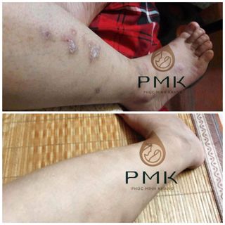 TINH CHẤT MỜ THÂM ĐA NĂNG PHÚC MINH KHANG