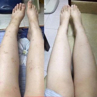 Tinh chất xoá thâm Ngọc Thiên Hương, xoá thâm body,thâm nách,thâm mụn,thâm môi,thâm mắt giúp da trắng tự nhiên(date mới)