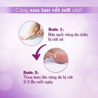 KEM TRỊ NỨT GÓT CHÂN ORISS 30G